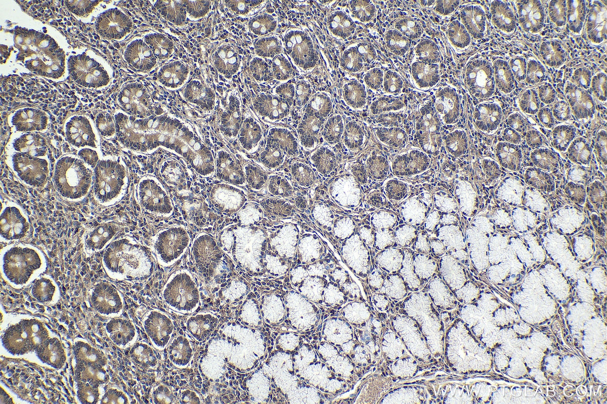 Immunohistochemical analysis of paraffin-embedded human stomach cancer tissue slide using KHC1803 (AKNA IHC Kit).