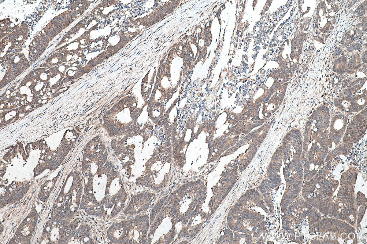 Immunohistochemical analysis of paraffin-embedded human colon cancer tissue slide using KHC0571 (AKR1A1 IHC Kit).