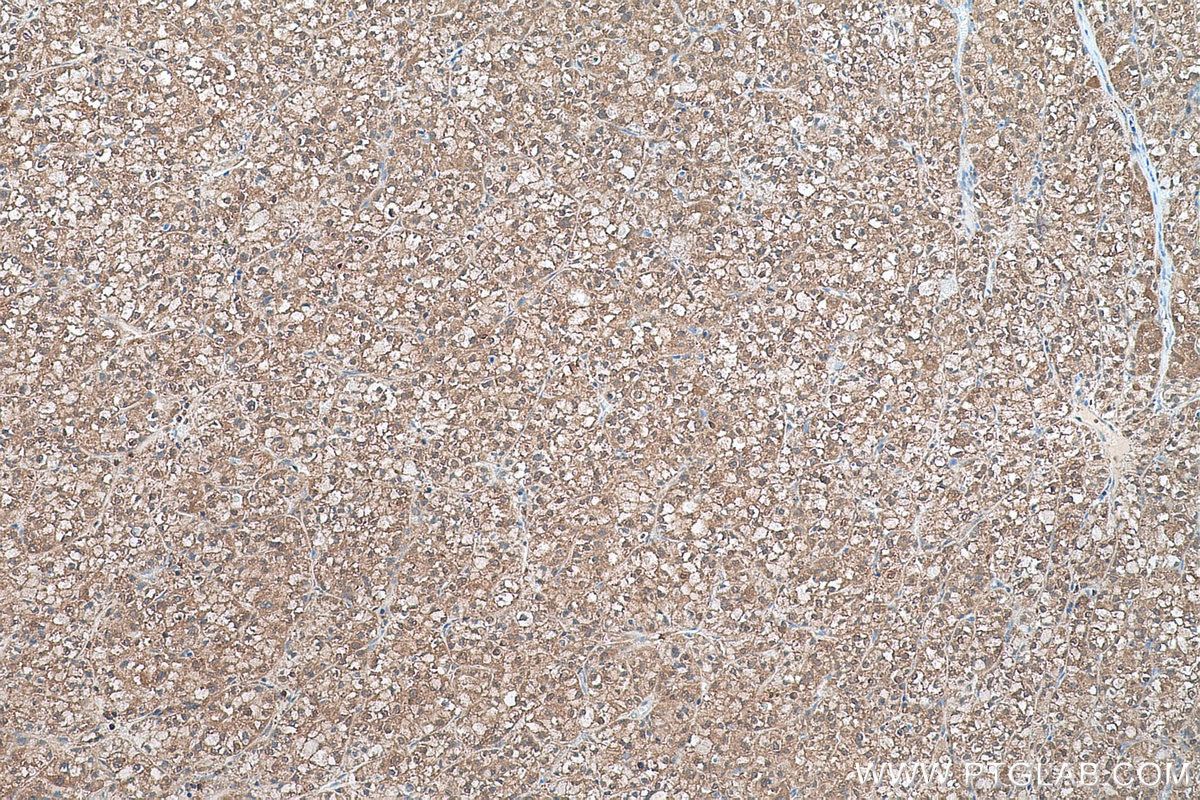 Immunohistochemical analysis of paraffin-embedded human liver cancer tissue slide using KHC0571 (AKR1A1 IHC Kit).