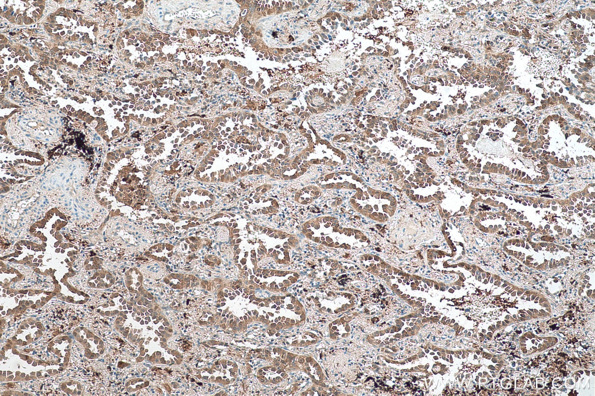 Immunohistochemical analysis of paraffin-embedded human lung cancer tissue slide using KHC0571 (AKR1A1 IHC Kit).