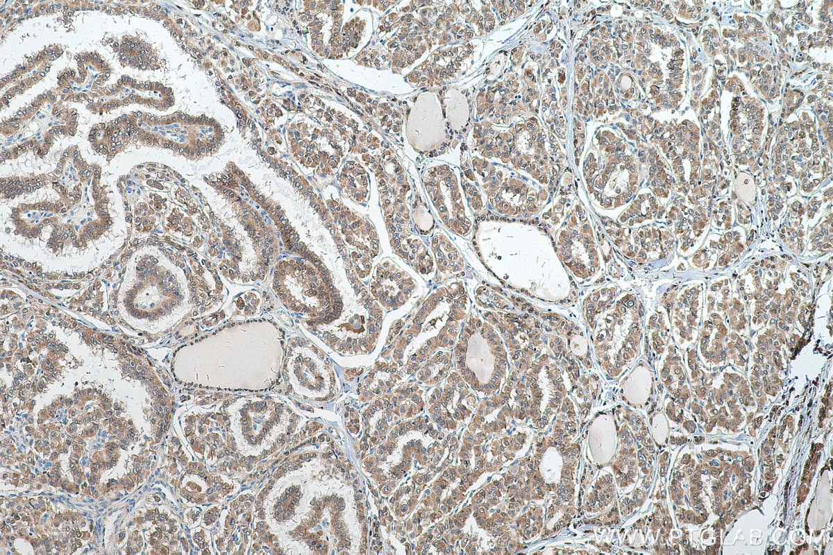 Immunohistochemical analysis of paraffin-embedded human thyroid cancer tissue slide using KHC0571 (AKR1A1 IHC Kit).