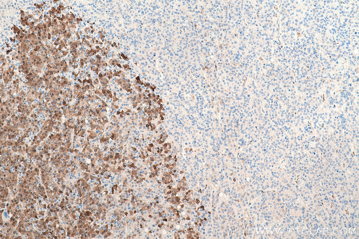 Immunohistochemical analysis of paraffin-embedded human liver cancer tissue slide using KHC0863 (AKR1B1 IHC Kit).