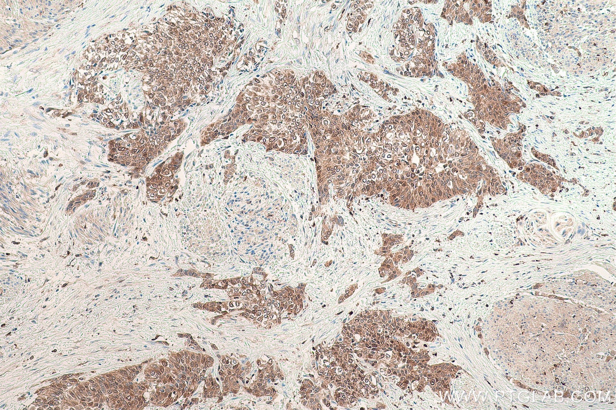 Immunohistochemical analysis of paraffin-embedded human urothelial carcinoma tissue slide using KHC0863 (AKR1B1 IHC Kit).