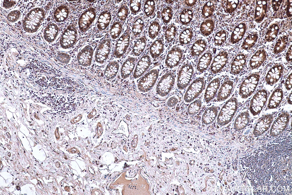 Immunohistochemical analysis of paraffin-embedded human colon tissue slide using KHC0665 (AKR1B10 IHC Kit).