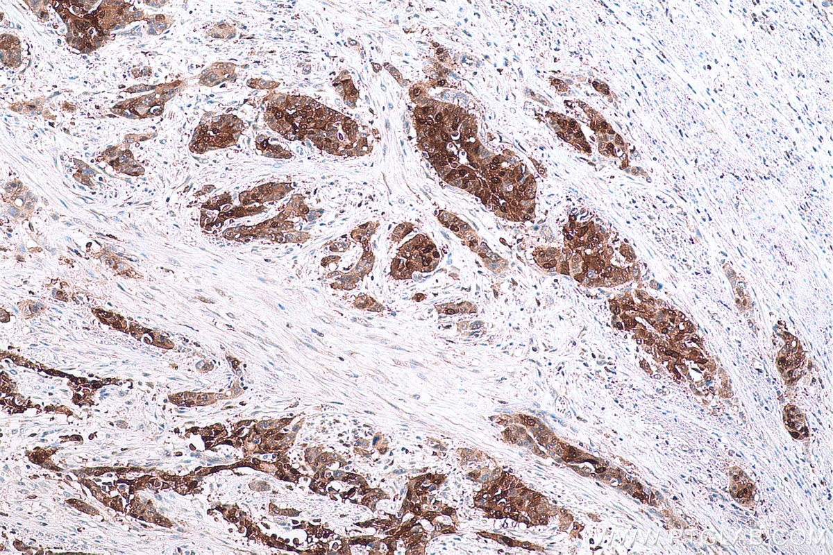 Immunohistochemical analysis of paraffin-embedded human oesophagus cancer tissue slide using KHC0665 (AKR1B10 IHC Kit).