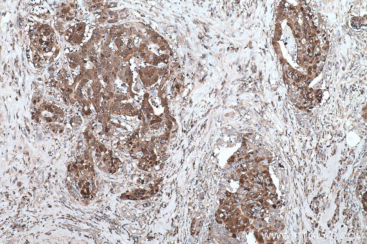 Immunohistochemical analysis of paraffin-embedded human stomach cancer tissue slide using KHC0665 (AKR1B10 IHC Kit).