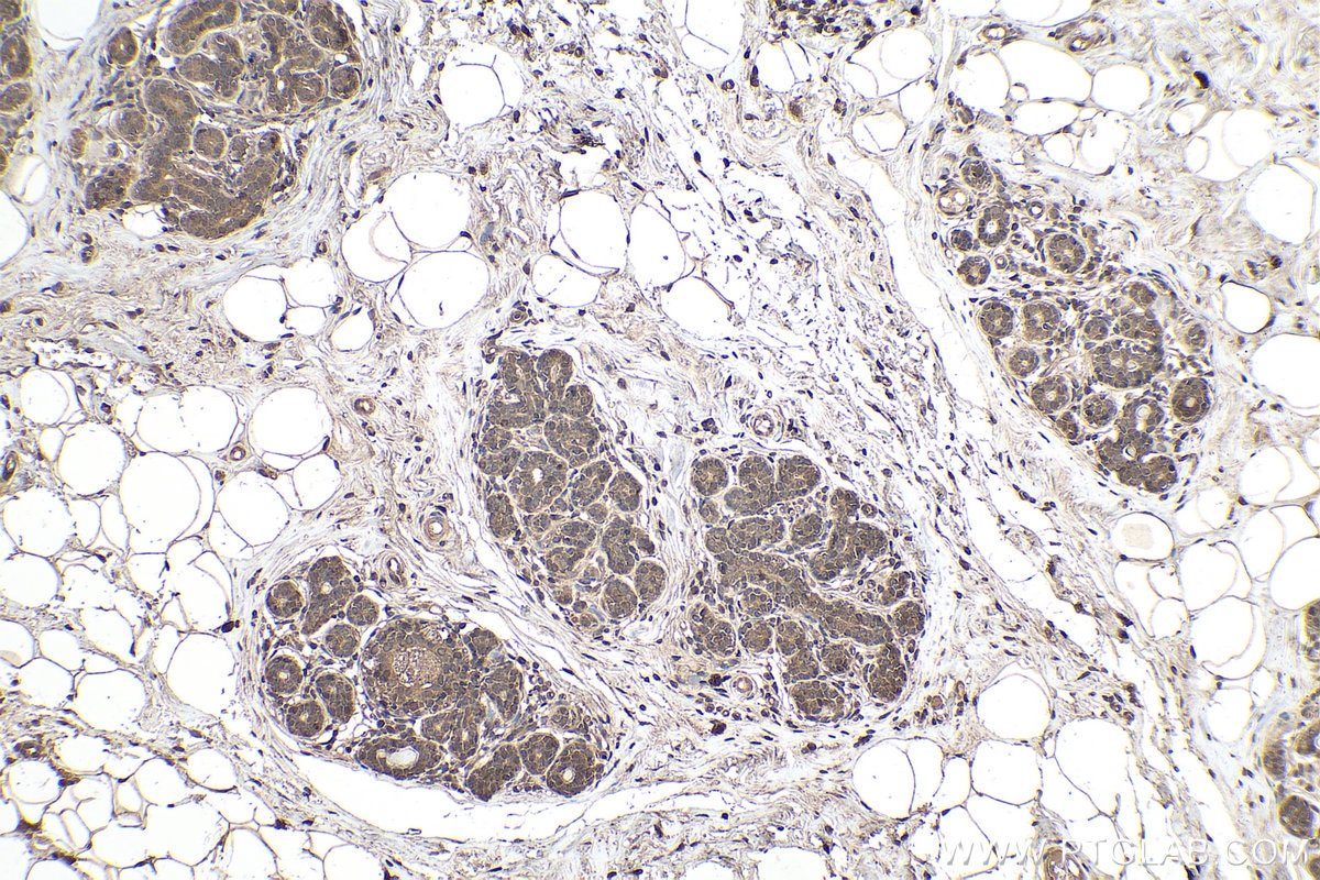 Immunohistochemical analysis of paraffin-embedded human breast cancer tissue slide using KHC0115 (AKT IHC Kit).