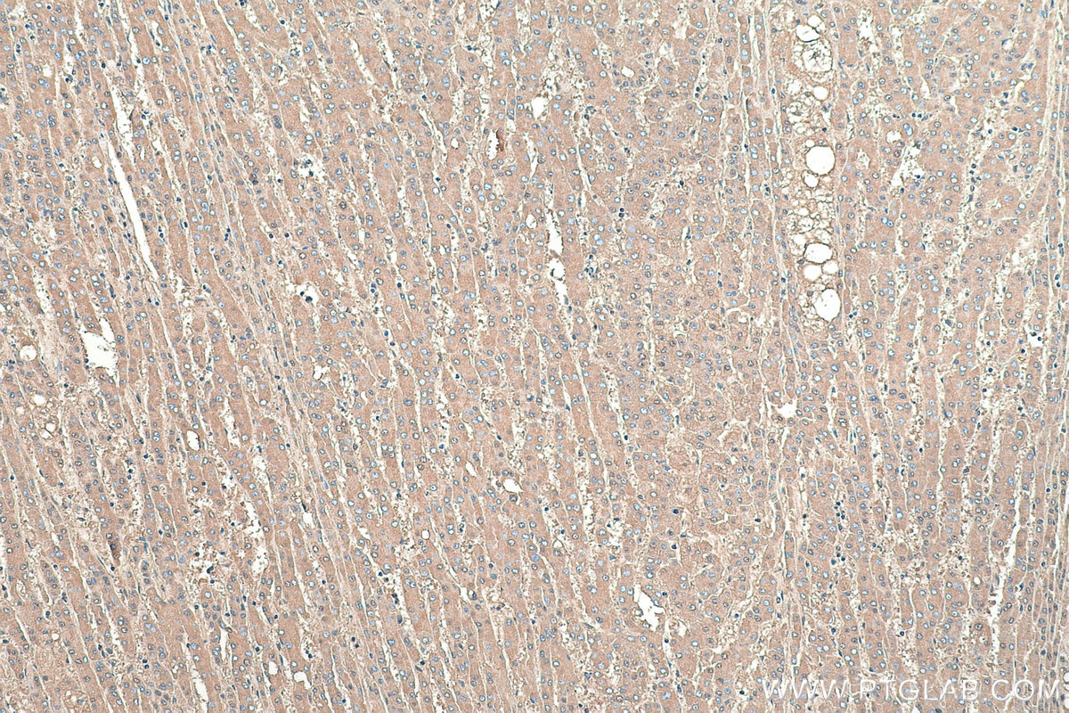 Immunohistochemical analysis of paraffin-embedded human liver cancer tissue slide using KHC0376 (ALB IHC Kit).