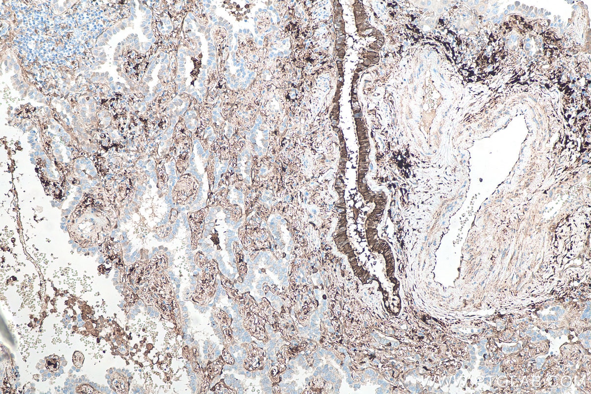 Immunohistochemical analysis of paraffin-embedded human lung cancer tissue slide using KHC0084 (ALDH1A1 IHC Kit).