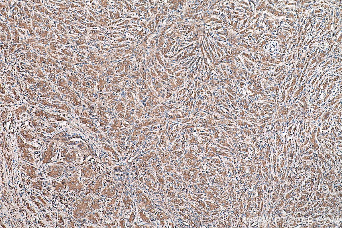 Immunohistochemical analysis of paraffin-embedded human prostate cancer tissue slide using KHC0216 (ALDH1A2 IHC Kit).