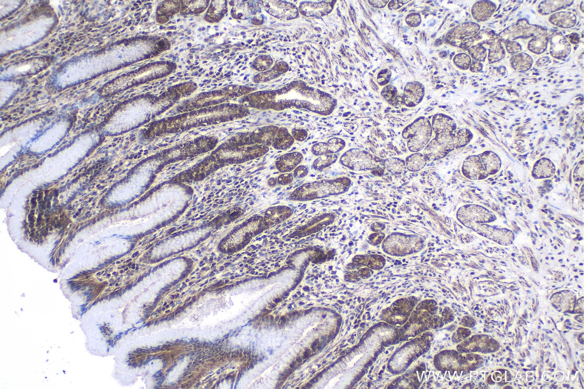 Immunohistochemical analysis of paraffin-embedded human stomach cancer tissue slide using KHC1045 (ALDH1B1 IHC Kit).