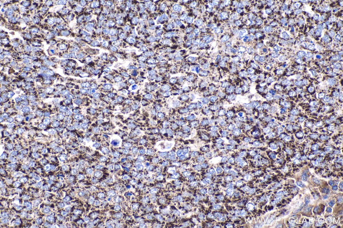 Immunohistochemical analysis of paraffin-embedded human ovary tumor tissue slide using KHC1045 (ALDH1B1 IHC Kit).