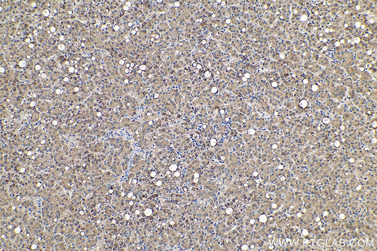 Immunohistochemical analysis of paraffin-embedded human liver cancer tissue slide using KHC0690 (ALDH3A1 IHC Kit).