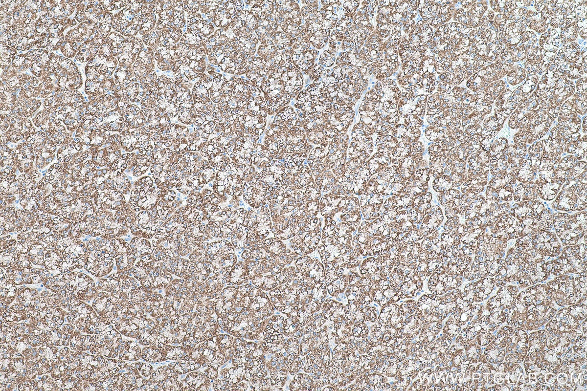 Immunohistochemical analysis of paraffin-embedded human liver cancer tissue slide using KHC0525 (ALDH4A1 IHC Kit).