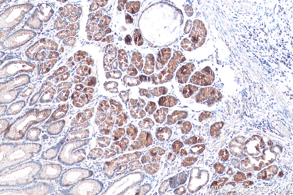 Immunohistochemical analysis of paraffin-embedded human stomach cancer(NAT) tissue slide using KHC0545 (ALDH6A1 IHC Kit).