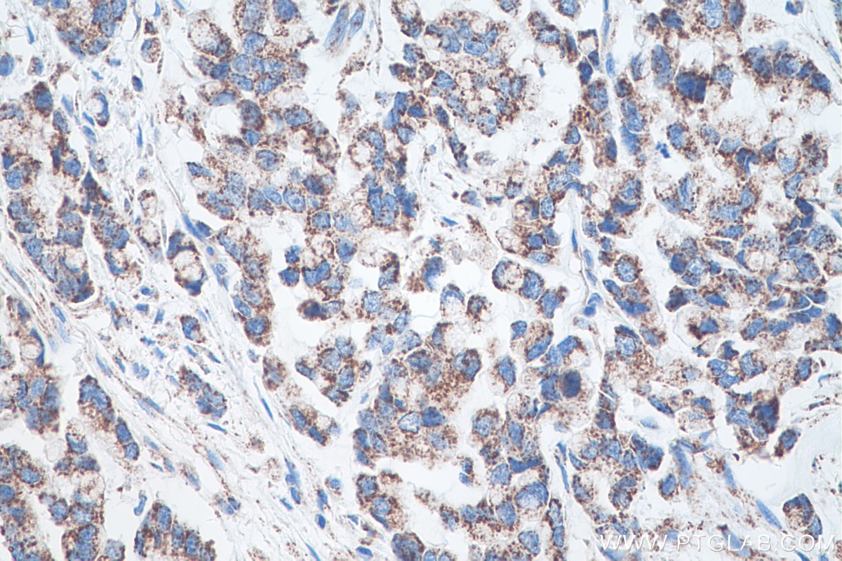 Immunohistochemical analysis of paraffin-embedded human colon cancer tissue slide using KHC0545 (ALDH6A1 IHC Kit).