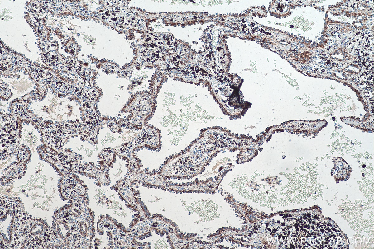Immunohistochemical analysis of paraffin-embedded human lung cancer tissue slide using KHC0545 (ALDH6A1 IHC Kit).