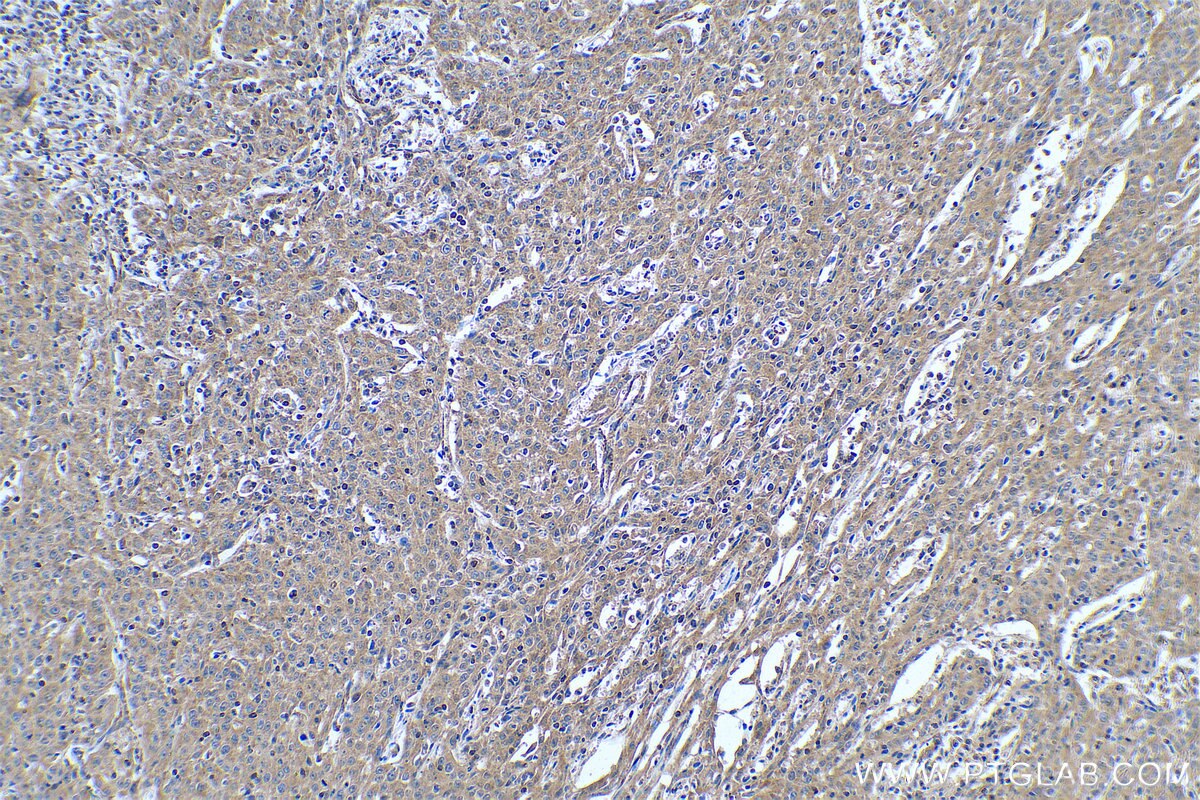 Immunohistochemical analysis of paraffin-embedded human cervical cancer tissue slide using KHC0887 (ALDH9A1 IHC Kit).