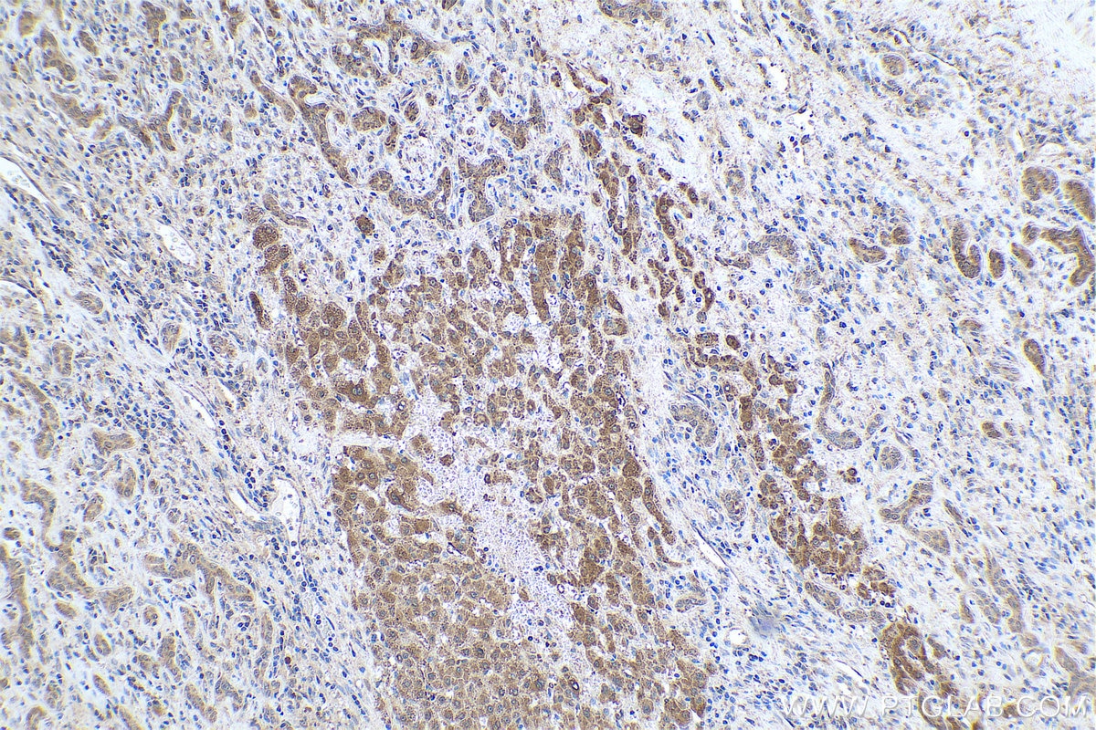 Immunohistochemical analysis of paraffin-embedded human liver cancer tissue slide using KHC0887 (ALDH9A1 IHC Kit).