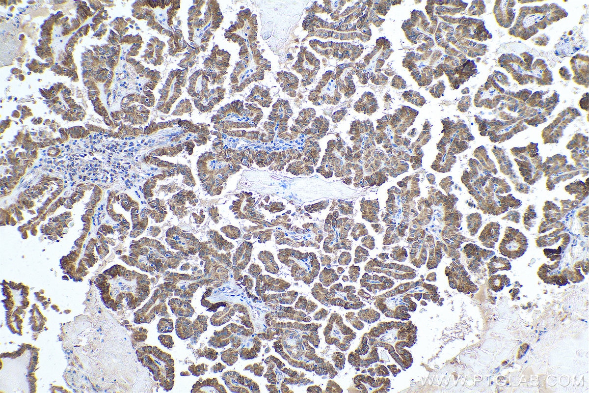 Immunohistochemical analysis of paraffin-embedded human thyroid cancer tissue slide using KHC0887 (ALDH9A1 IHC Kit).
