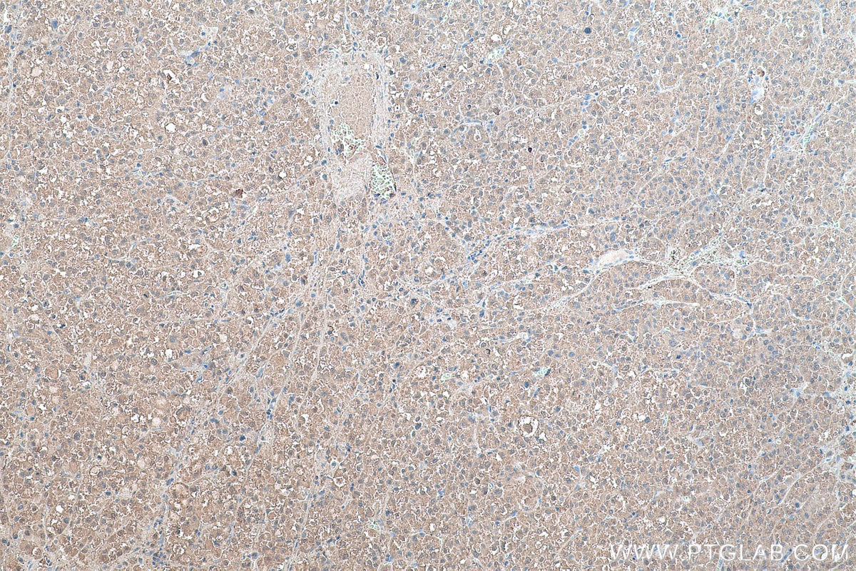 Immunohistochemical analysis of paraffin-embedded human liver cancer tissue slide using KHC0488 (ALDOA IHC Kit).