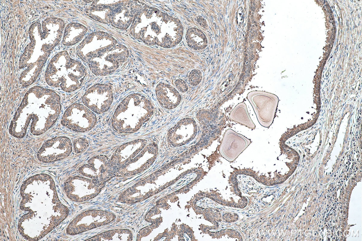 Immunohistochemical analysis of paraffin-embedded human prostate cancer tissue slide using KHC0488 (ALDOA IHC Kit).