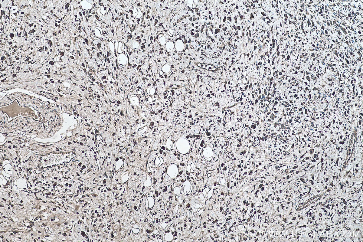 Immunohistochemical analysis of paraffin-embedded human stomach cancer tissue slide using KHC0489 (ALDOB IHC Kit).