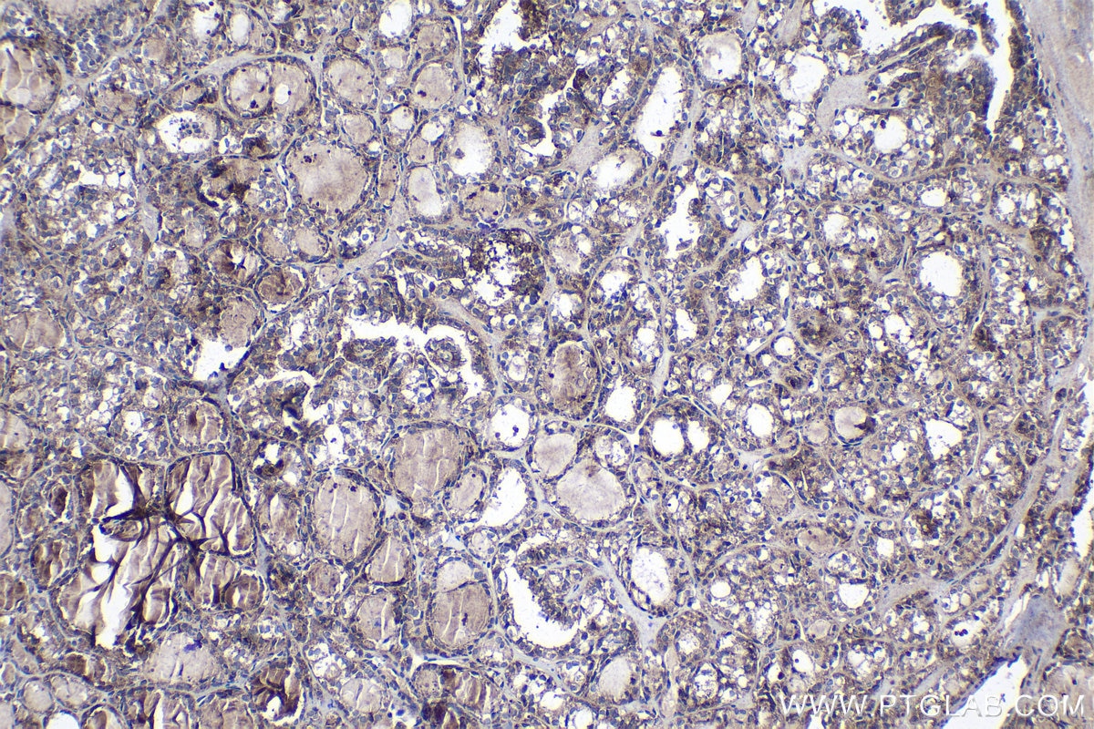 Immunohistochemical analysis of paraffin-embedded human thyroid cancer tissue slide using KHC1350 (ALG3 IHC Kit).