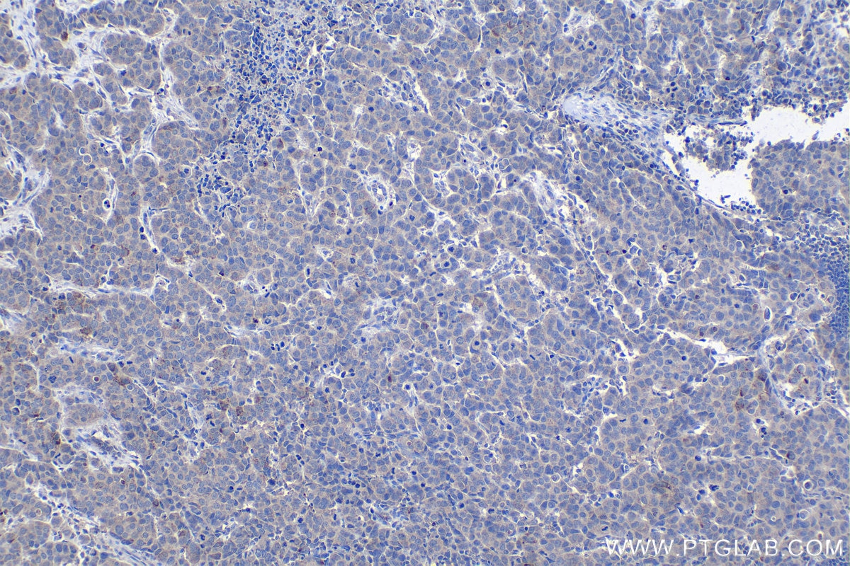 Immunohistochemical analysis of paraffin-embedded human breast cancer tissue slide using KHC1350 (ALG3 IHC Kit).
