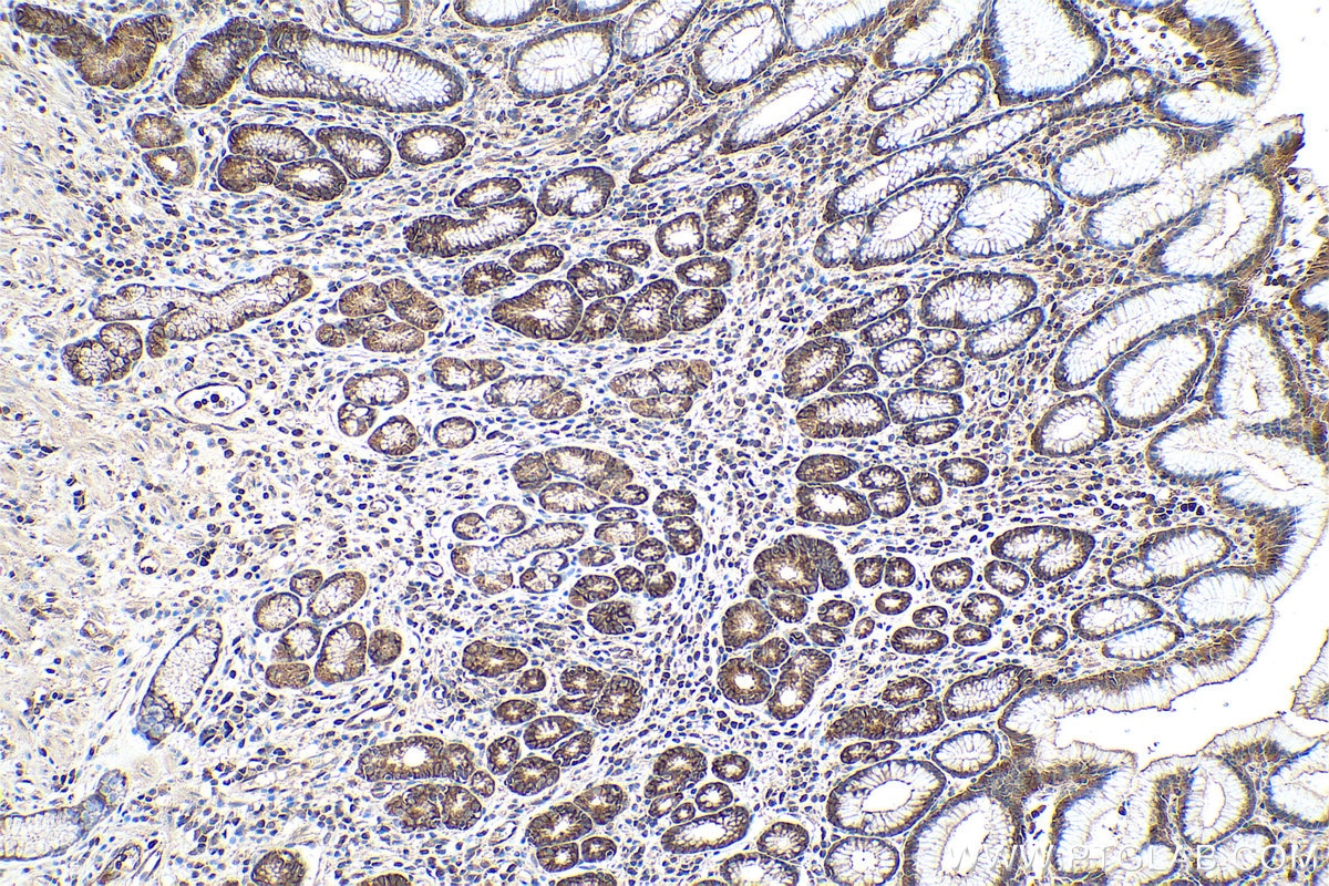 Immunohistochemical analysis of paraffin-embedded human stomach cancer tissue slide using KHC0873 (ALIX IHC Kit).