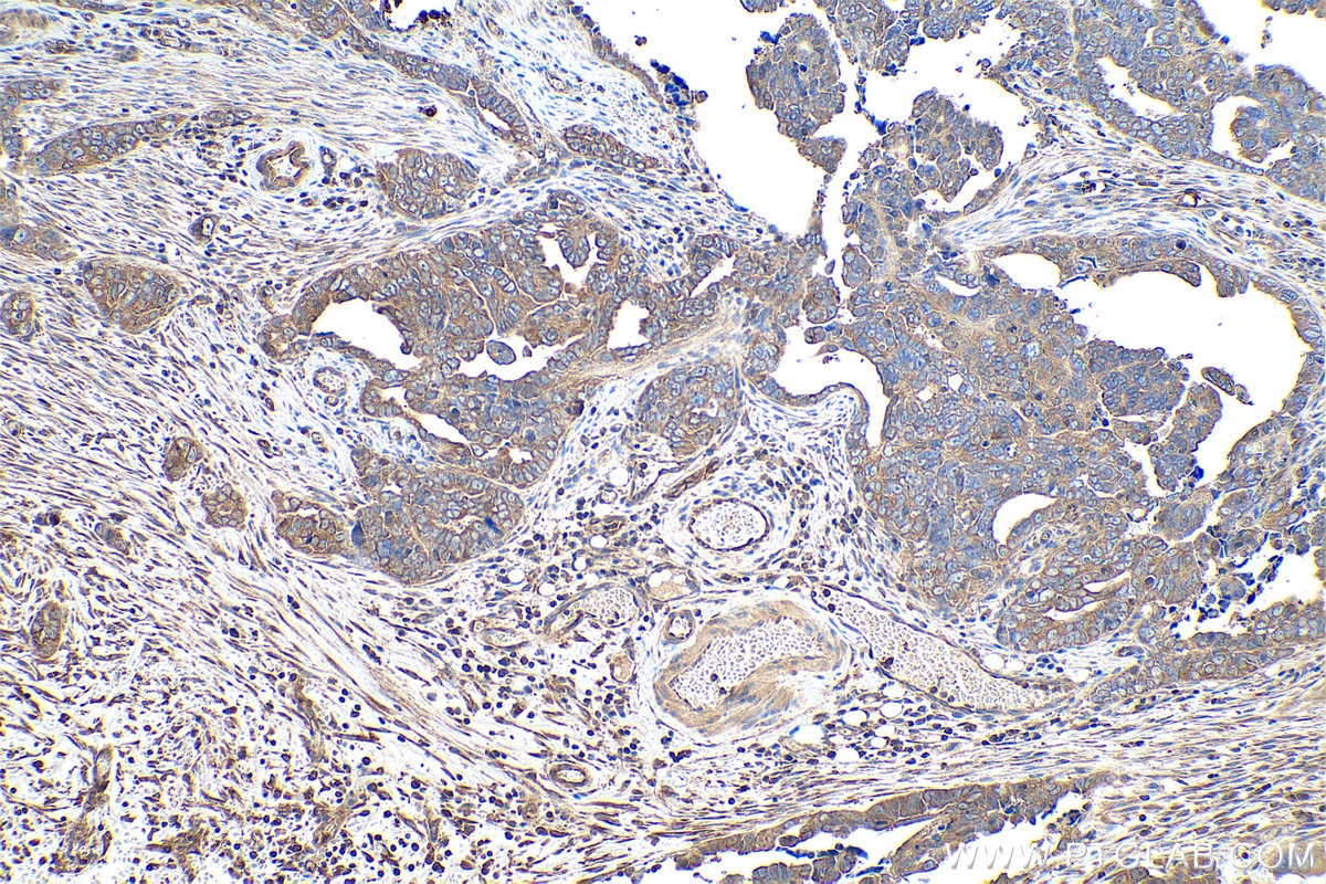 Immunohistochemical analysis of paraffin-embedded human ovary tumor tissue slide using KHC0873 (ALIX IHC Kit).