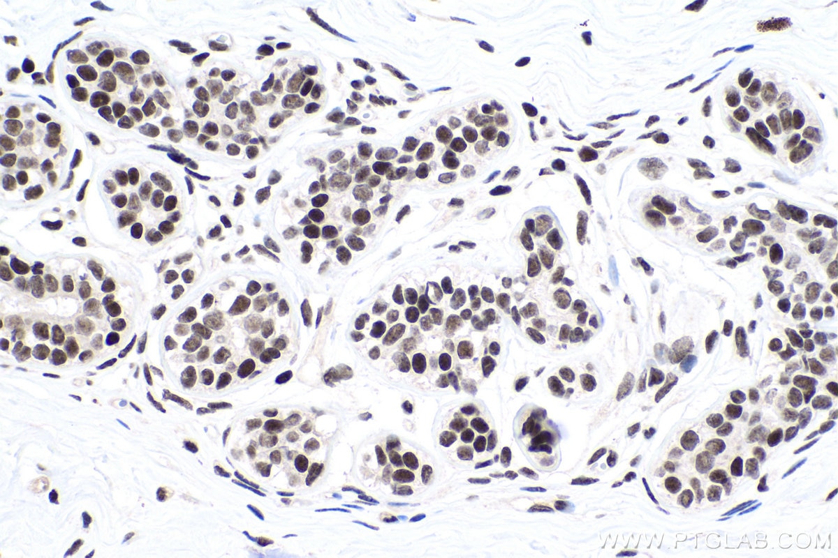 Immunohistochemical analysis of paraffin-embedded human breast cancer tissue slide using KHC0154 (ALKBH5 IHC Kit).
