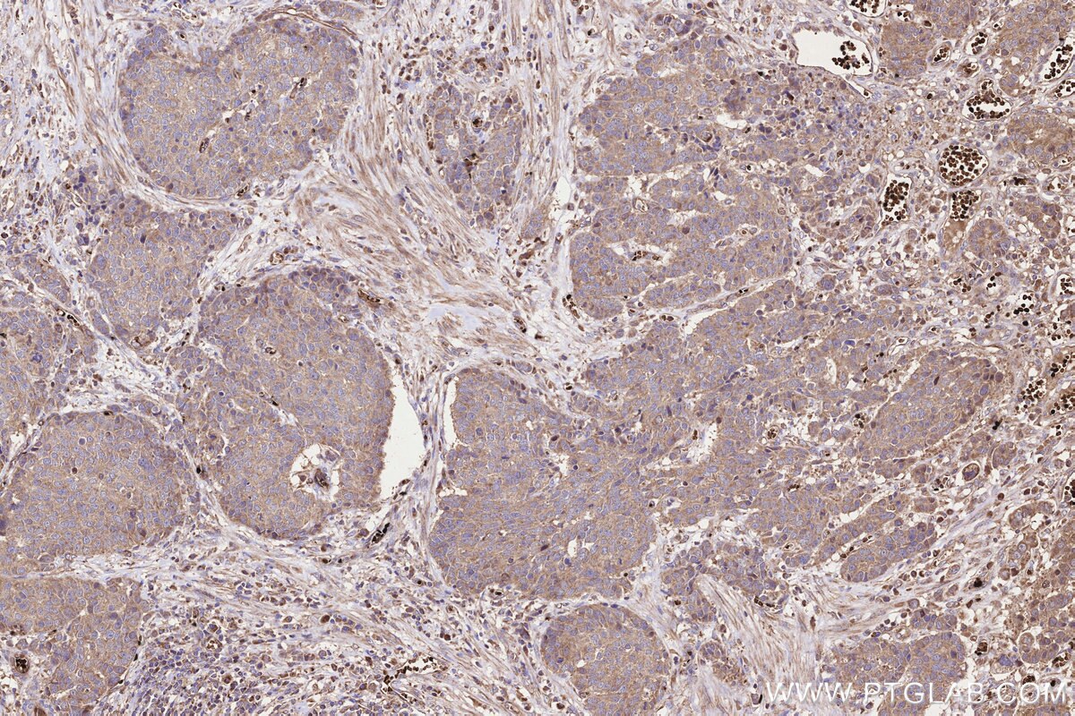 Immunohistochemical analysis of paraffin-embedded human stomach cancer tissue slide using KHC3231 (ALR IHC Kit).