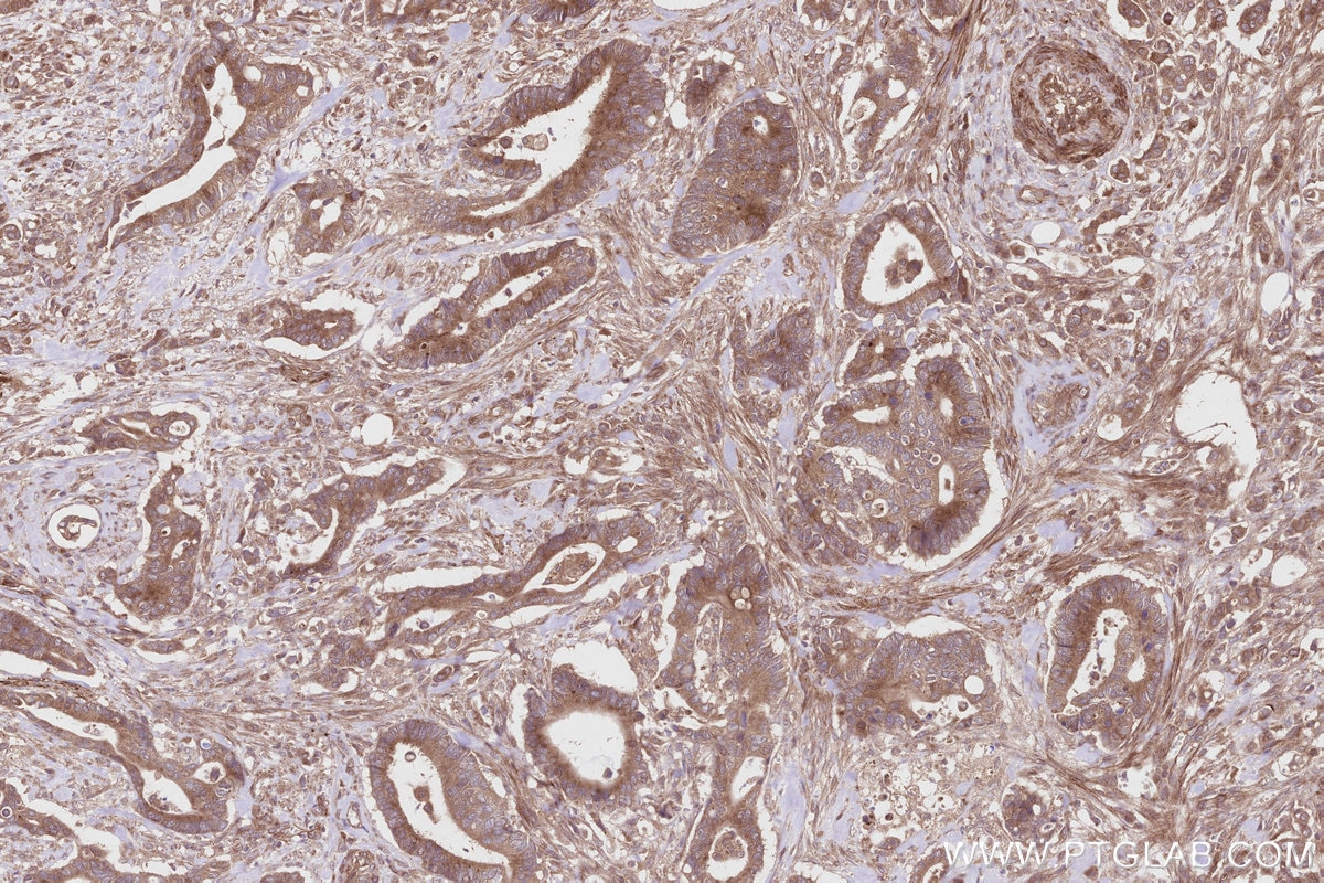 Immunohistochemical analysis of paraffin-embedded human rectal cancer tissue slide using KHC2819 (ALS2 IHC Kit).