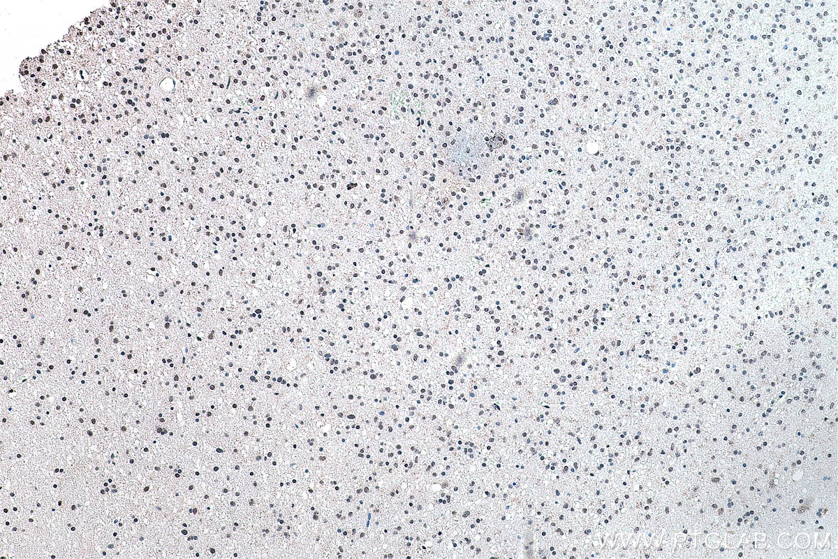 Immunohistochemical analysis of paraffin-embedded human gliomas tissue slide using KHC0175 (ALY IHC Kit).