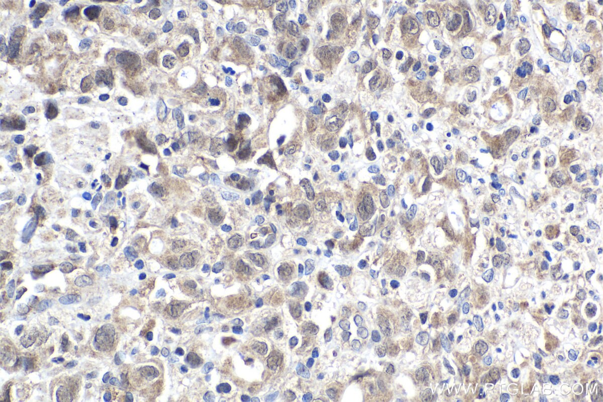 Immunohistochemical analysis of paraffin-embedded human stomach cancer tissue slide using KHC1915 (AMBRA1 IHC Kit).