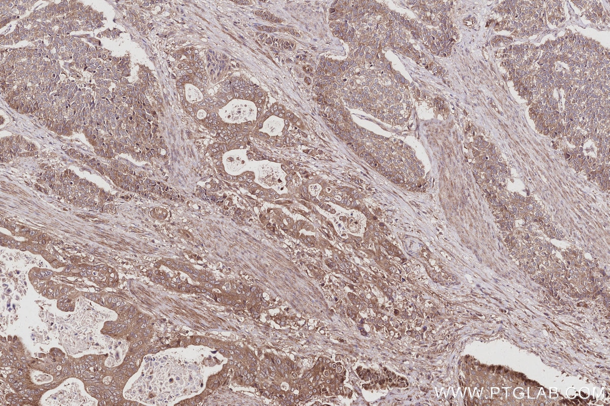 Immunohistochemical analysis of paraffin-embedded human stomach cancer tissue slide using KHC3030 (AMFR/GP78 IHC Kit). Immunohistochemical analysis of paraffin-embedded human stomach cancer tissue slide using KHC3030 (AMFR/GP78 IHC Kit).