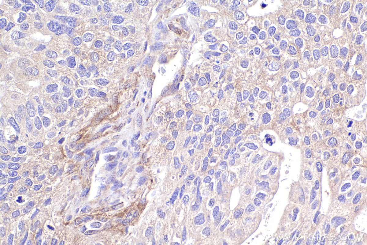 Immunohistochemical analysis of paraffin-embedded human ovary tumor tissue slide using KHC2382 (AMPD2 IHC Kit).