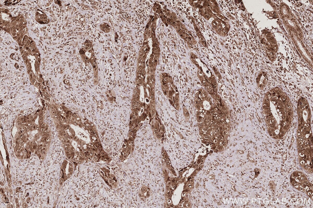Immunohistochemical analysis of paraffin-embedded human pancreas cancer tissue slide using KHC3021 (ANAPC5 IHC Kit).