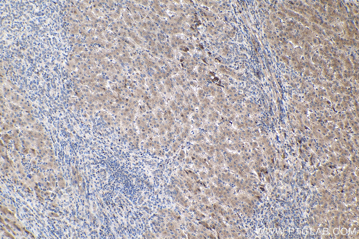 Immunohistochemical analysis of paraffin-embedded human liver cancer tissue slide using KHC1505 (ANG IHC Kit).