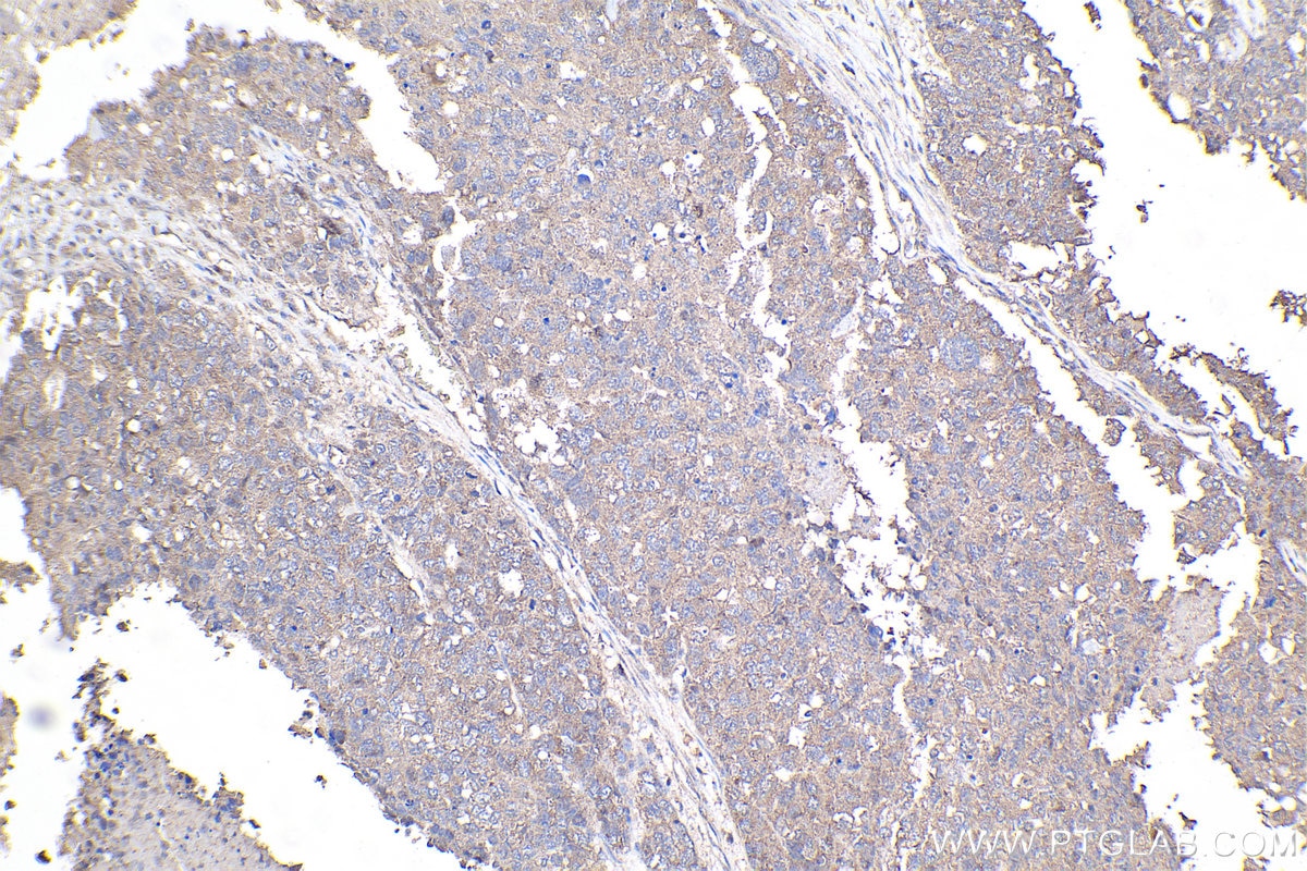 Immunohistochemical analysis of paraffin-embedded human ovary cancer tissue slide using KHC2108 (ANKRD17 IHC Kit).