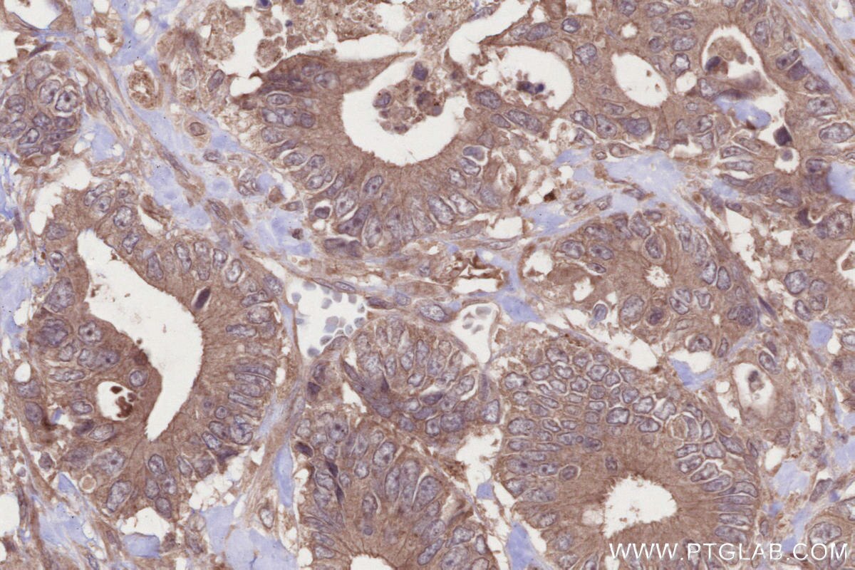 Immunohistochemical analysis of paraffin-embedded human rectal cancer tissue slide using KHC2682 (ANKRD53 IHC Kit).
