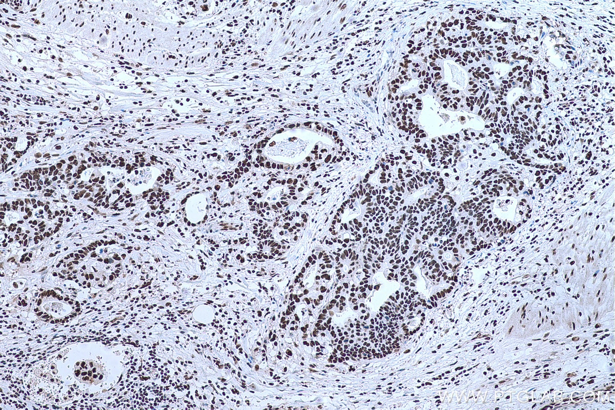 Immunohistochemical analysis of paraffin-embedded human stomach cancer tissue slide using KHC0670 (ANP32A IHC Kit).