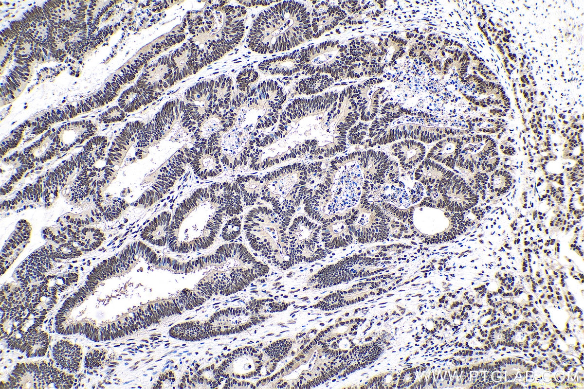 Immunohistochemical analysis of paraffin-embedded human colon cancer tissue slide using KHC0670 (ANP32A IHC Kit).