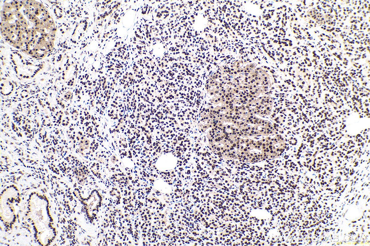 Immunohistochemical analysis of paraffin-embedded human pancreas cancer tissue slide using KHC0670 (ANP32A IHC Kit).