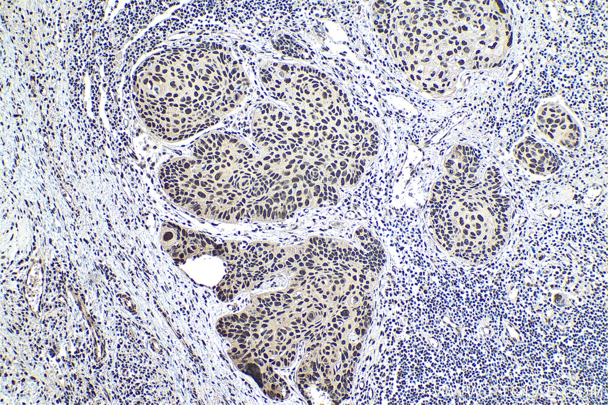 Immunohistochemical analysis of paraffin-embedded human lung cancer tissue slide using KHC1850 (ANP32B IHC Kit).