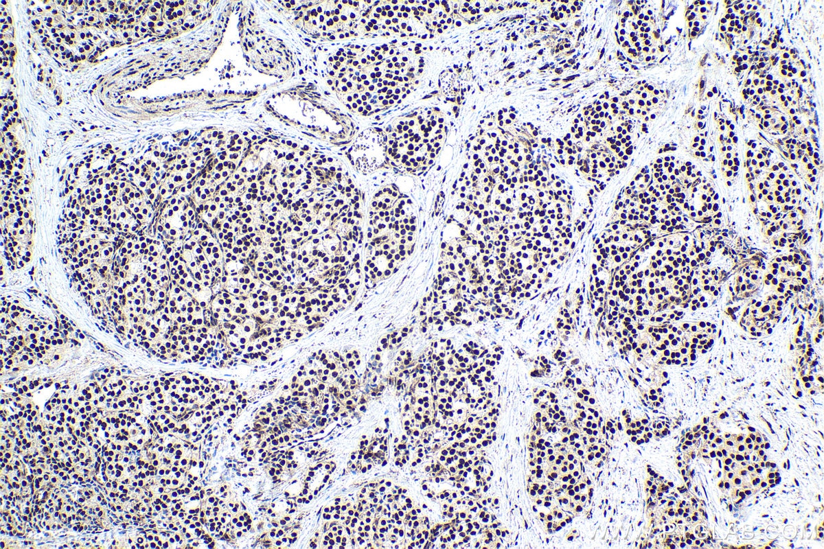 Immunohistochemical analysis of paraffin-embedded human thyroid cancer tissue slide using KHC1850 (ANP32B IHC Kit).