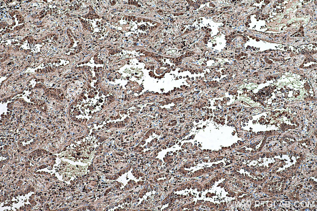 Immunohistochemical analysis of paraffin-embedded human lung cancer tissue slide using KHC0399 (ANXA1 IHC Kit).