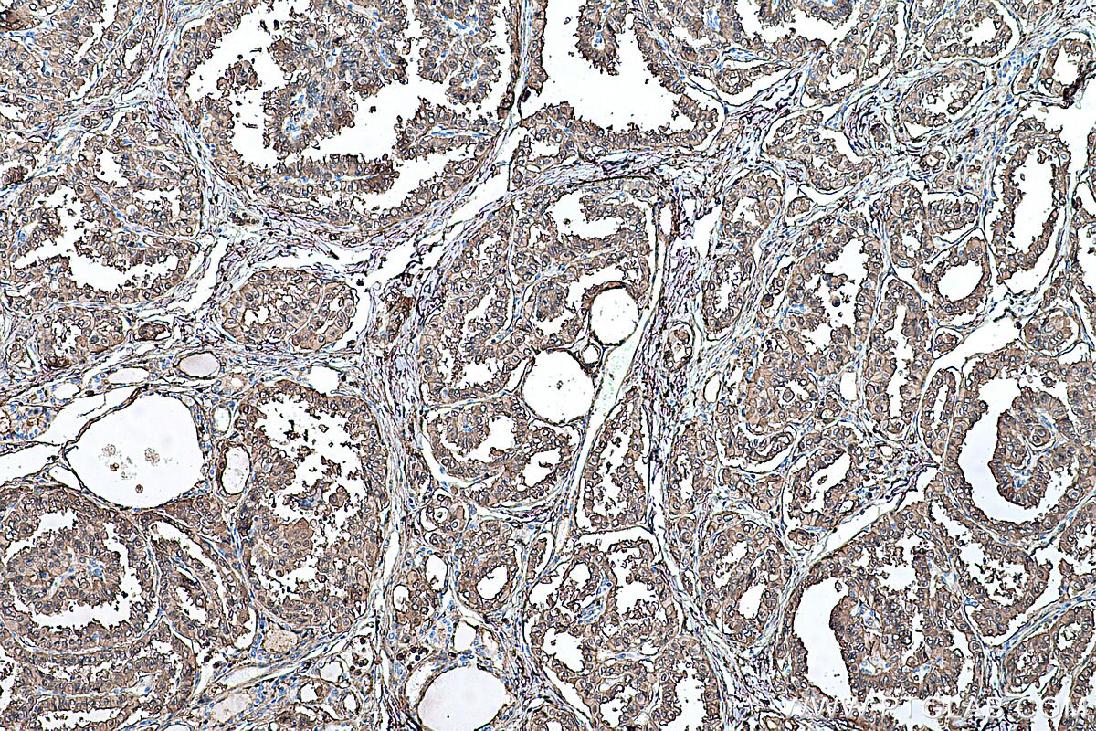 Immunohistochemical analysis of paraffin-embedded human thyroid cancer tissue slide using KHC0399 (ANXA1 IHC Kit).