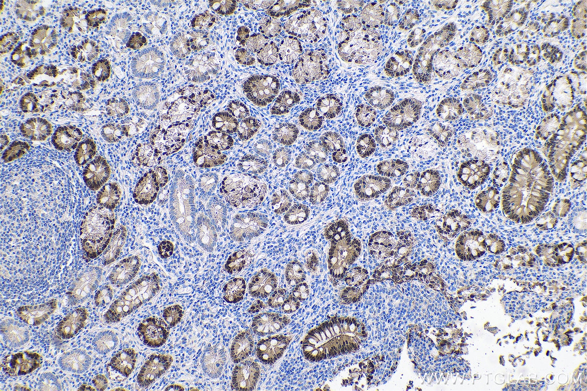 Immunohistochemical analysis of paraffin-embedded human stomach cancer tissue slide using KHC0692 (ANXA10 IHC Kit).